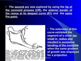 • The second arc was explored by using the tip of
the coronoid process (CR), the anterior border of
the ramus at its deepest curve (R1) and the same
Pm point.
• The extension of this
curve exhibited the
segment of a circle too
small in radius and
resulted in excessive
bending of the mandible
when the same gradient
of growth was employed
for a projection.
www.indiandentalacademy.com
 