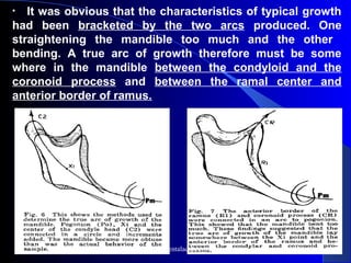 • It was obvious that the characteristics of typical growth
had been bracketed by the two arcs produced. One
straightening the mandible too much and the other
bending. A true arc of growth therefore must be some
where in the mandible between the condyloid and the
coronoid process and between the ramal center and
anterior border of ramus.
      
www.indiandentalacademy.com
 