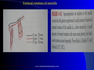 Vertical rotation of maxilla
www.indiandentalacademy.com
 