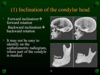 Maxilla Rotation Device growth rotation orthodontics mds pg mandible and maxilla | PPT