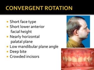 Growth rotations of the jaws | PPTX