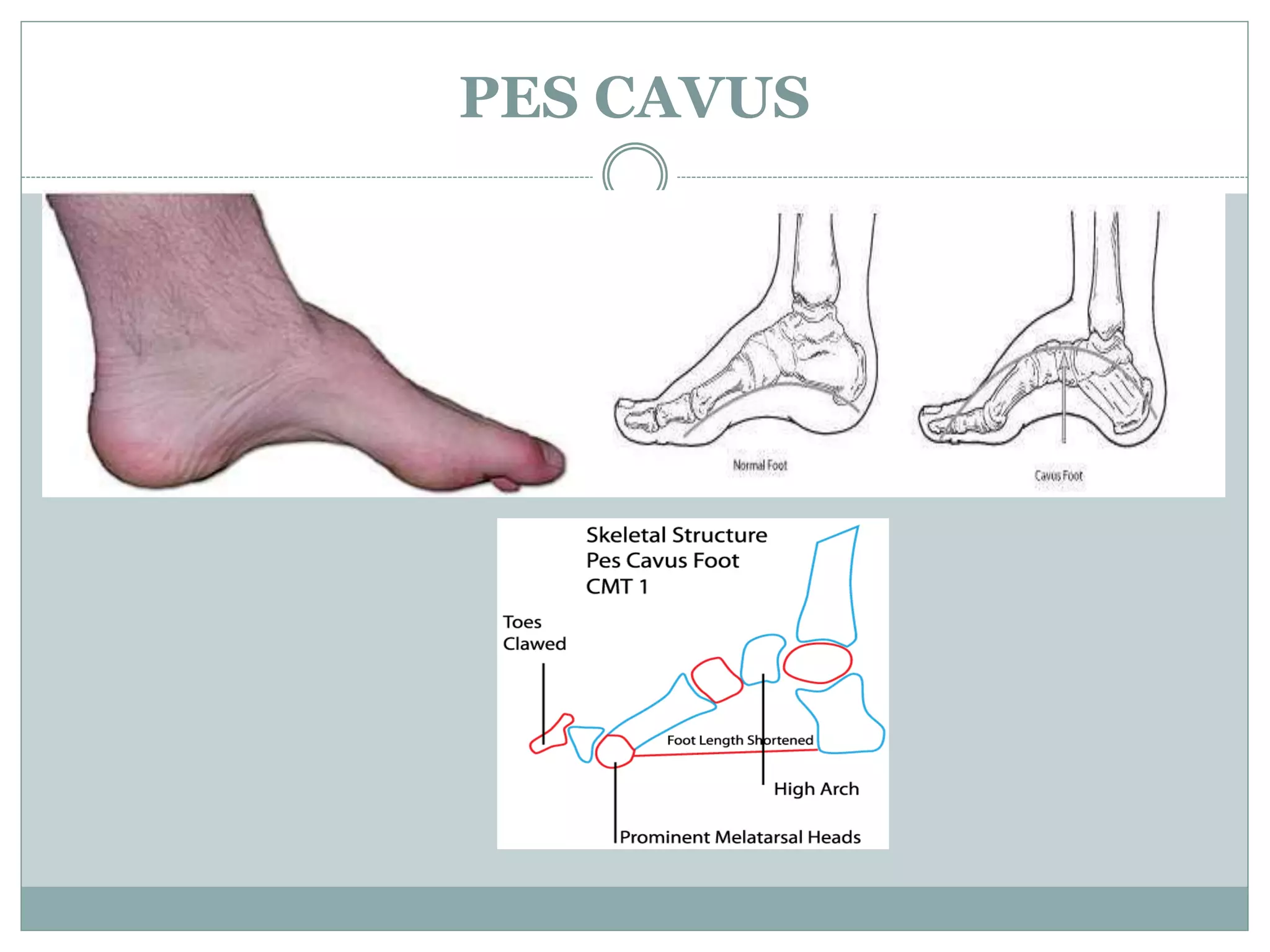 PES CAVUS
 