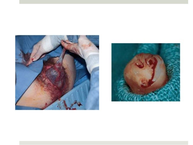 Pregnancy Complications - Whitney Lewis