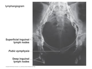 43
lymphangiogram
 