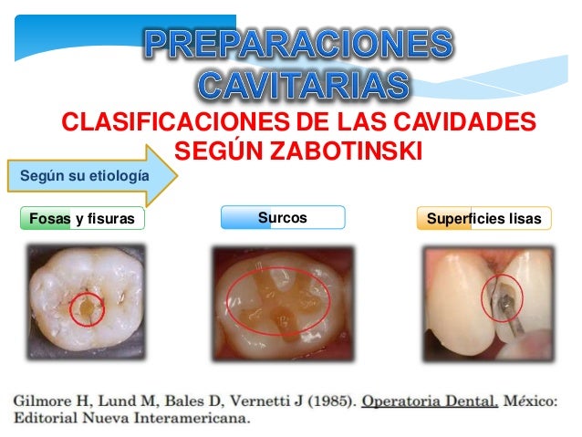 Preparaciones-Cavitarias