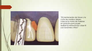 “El mantenerdor de Hawe y la
cuña de madera deben
colocar la matriz de Poliéster
en posición para poder
realizar la restauración clase III
con Ionómero vítreo”
 