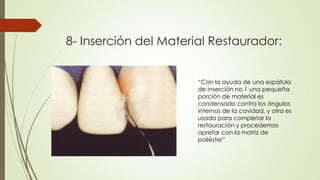 8- Inserción del Material Restaurador:
“Con la ayuda de una espátula
de inserción no.1 una pequeña
porción de material es
condensado contra los ángulos
internos de la cavidad, y otra es
usada para completar la
restauración y procedemos
apretar con la matriz de
poliéster”
 