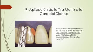 9- Aplicación de la Tira Matriz a la
Cara del Diente:
“ con la ayuda del mantenedor
de Hawe y la cuña de madera
se comprime el ionómero de
vidrio hasta su posterior
endurecimiento (05 minutos
mínimo)”
 