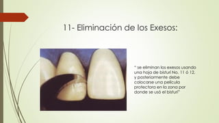 11- Eliminación de los Exesos:
“ se eliminan los exesos usando
una hoja de bisturí No. 11 ó 12,
y posteriormente debe
colocarse una película
protectora en la zona por
donde se usó el bisturí”
 