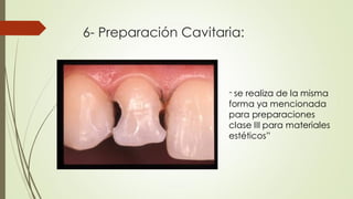 6- Preparación Cavitaria:
“ se realiza de la misma
forma ya mencionada
para preparaciones
clase III para materiales
estéticos”
 