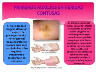Si no se produce
ninguna alteración
o desgarro de
planos profundos.
Por efecto del
pequeño golpe se
produce en la zona
enrojecimiento. No
requieren
tratamiento y
desaparecen en
unos días.
Si el golpe es un poco
mayor se pueden afectar
los capilares que por la
acción del golpe se
rompen produciendo
una minúscula pérdida
sanguínea, se le llama
equimosis o hematoma,
la piel se torna de color
amoratado. Esta
equimosis desaparece al
cabo de unos días.
Aplicación de hielo o
compresas frías y la zona
en reposo
 