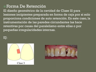 Forma De Retención
El diseño geométrico de la cavidad de Clase lll para
lesiones incipientes preparada en forma de caja por si solo
proporciona condiciones de auto retención. En este caso, la
instrumentación de las paredes circundantes las hace
retentivas por causa del paralelismo entre ellas o por
pequeñas irregularidades internas.
EJ:
 