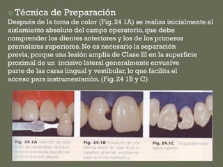  Técnica de Preparación
Después de la toma de color (Fig.24 1A) se realiza inicialmente el
aislamiento absoluto del campo operatorio,que debe
comprender los dientes anteriores y los de los primeros
premolares superiores.No es necesario la separación
previa,porque una lesión amplia de Clase lll en la superficie
proximal de un incisivo lateral generalmente envuelve
parte de las caras lingual y vestibular,lo que facilita el
acceso para instrumentación.(Fig.24 1B y C)
 