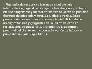  Una cuña de madera es insertada en el espacio
interdentario gingival para alejar la tela de goma y el tejido
blando subyacente y mantener una tira de acero en posición
después de adaptada y bruñida al diente vecino. Estos
procedimientos mejoran el acceso y la visibilidad de las
áreas proximales y gingivales de la lesión de caries o
restauración insatisfactoria, protegiendo la superficie
proximal del diente vecino contra la acción de la boca o
punta diamantada (Fig.24.2a 4).
 
