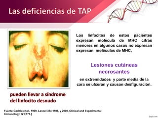 Los linfocitos de estos pacientes
expresan molécula de MHC cifras
menores en algunos casos no expresan
expresan moléculas de MHC.
Lesiones cutáneas
necrosantes
en extremidades y parte media de la
cara se ulceran y causan desfiguración.
Fuente:Gadola et al., 1999, Lancet 354:1598, y 2000, Clinical and Experimental
Immunology 121:173.]
 