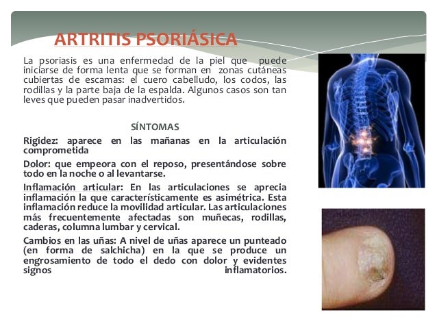 El tratamiento de la psoriasis el ungüento