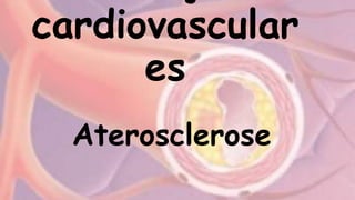 cardiovascular
es
Aterosclerose
 