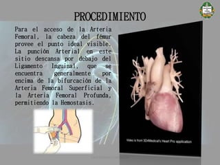 PROCEDIMIENTO
Para el acceso de la Arteria
Femoral, la cabeza del fémur
provee el punto ideal visible.
La punción Arterial en este
sitio descansa por debajo del
Ligamento Inguinal, que se
encuentra generalmente por
encima de la bifurcación de la
Arteria Femoral Superficial y
la Arteria Femoral Profunda,
permitiendo la Hemostasis.
CATETERISMO CARDÍACO
 
