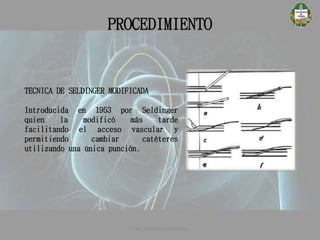 PROCEDIMIENTO
TECNICA DE SELDINGER MODIFICADA
Introducida en 1953 por Seldinger
quien la modificó más tarde
facilitando el acceso vascular y
permitiendo cambiar catéteres
utilizando una única punción.
CATETERISMO CARDÍACO
 
