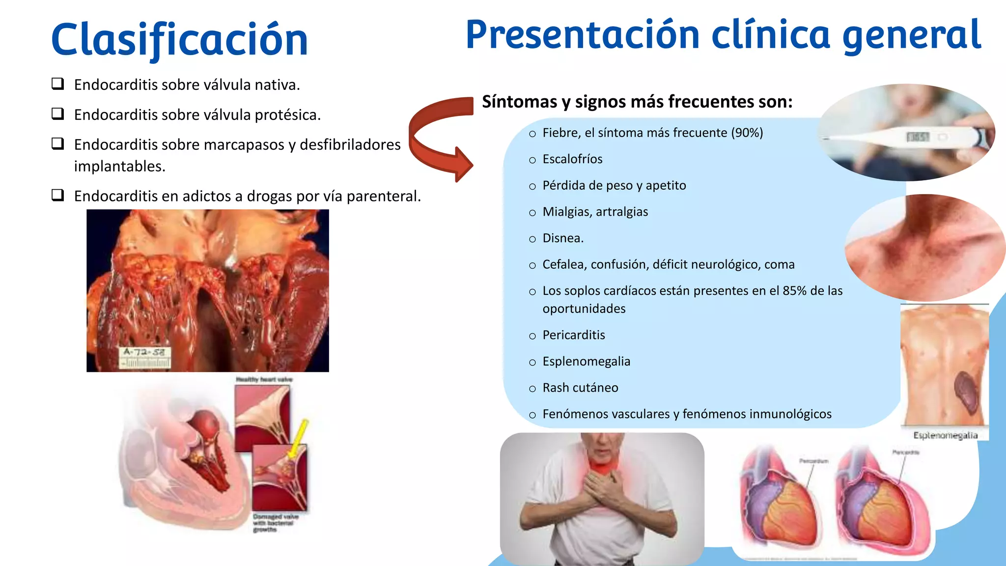 Endocarditis T ENDOCARDITIS INFECCIOSA.pptx