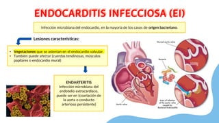 ENDOCARDITIS INFECCIOSA (EI)
ENDOCARDITIS INFECCIOSA (EI)
Infección microbiana del endocardio, en la mayoría de los casos de origen bacteriano.
• Vegetaciones que se asientan en el endocardio valvular.
• También puede afectar (cuerdas tendinosas, músculos
papilares o endocardio mural)
Lesiones características:
ENDARTERITIS
Infección microbiana del
endotelio extracardíaco,
puede ser en (coartación de
la aorta o conducto
arterioso persistente)
 