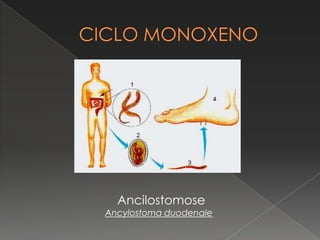 Ancilostomose
Ancylostoma duodenale
 