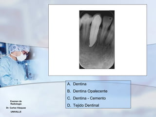 Examen de
Radiología
Dr. Carlos Vásquez
UNIVALLE
A. Dentina
B. Dentina Opalecente
C. Dentina - Cemento
D. Tejido Dentinal
 