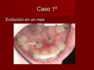 Caso 1º
Evolución en un mes




             Jesús Jover
 