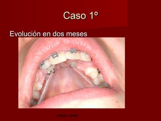Caso 1º
Evolución en dos meses




             Jesús Jover
 