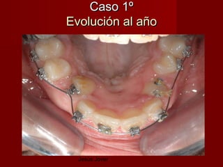 Caso 1º
Evolución al año




  Jesús Jover
 