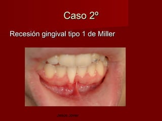 Caso 2º
Recesión gingival tipo 1 de Miller




               Jesús Jover
 