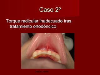 Caso 2º
Torque radicular inadecuado tras
 tratamiento ortodóncico




              Jesús Jover
 