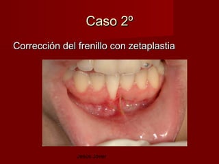 Caso 2º
Corrección del frenillo con zetaplastia




               Jesús Jover
 