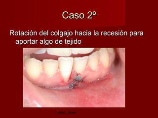 Caso 2º
Rotación del colgajo hacia la recesión para
 aportar algo de tejido




              Jesús Jover
 
