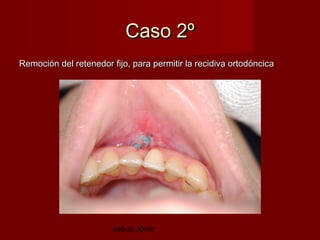 Caso 2º
Remoción del retenedor fijo, para permitir la recidiva ortodóncica




                        Jesús Jover
 