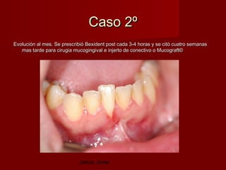 Caso 2º
Evolución al mes. Se prescribió Bexident post cada 3-4 horas y se citó cuatro semanas
   mas tarde para cirugia mucogingival e injerto de conectivo o Mucograft©




                            Jesús Jover
 