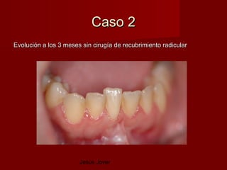 Caso 2
Evolución a los 3 meses sin cirugía de recubrimiento radicular




                       Jesús Jover
 