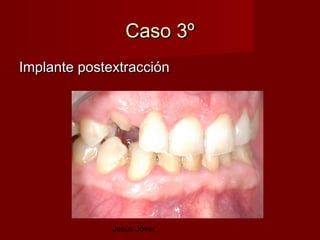 Caso 3º
Implante postextracción




              Jesús Jover
 