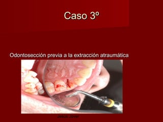 Caso 3º


Odontosección previa a la extracción atraumática




                   Jesús Jover
 