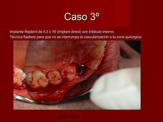 Caso 3º
Implante Replant de 4,3 x 16 (Implant direct) con trilóbulo interno.
Técnica flapless para que no se interrumpa la vascularización a la zona quirúrgica




                             Jesús Jover
 