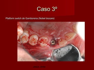 Caso 3º
Platform switch de Gamborena (Nobel biocare)




                        Jesús Jover
 