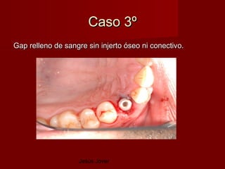 Caso 3º
Gap relleno de sangre sin injerto óseo ni conectivo.




                   Jesús Jover
 