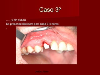 Caso 3º
……y sin sutura
Se prescribe Bexident post cada 3-4 horas
.




                      Jesús Jover
 