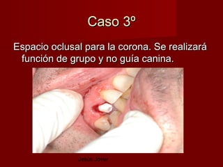 Caso 3º
Espacio oclusal para la corona. Se realizará
 función de grupo y no guía canina.




              Jesús Jover
 