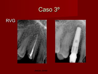 Caso 3º
RVG




      Jesús Jover
 
