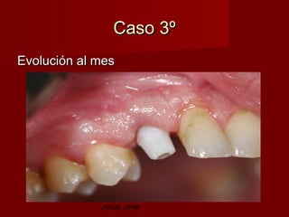 Caso 3º
Evolución al mes




             Jesús Jover
 