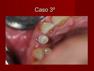 Caso 3º




Jesús Jover
 