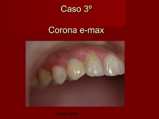 Caso 3º

Corona e-max




 Jesús Jover
 
