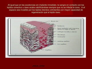 Al igual que en las exodoncias sin implante inmediato, la sangre en contacto con los
tejidos conectivo u óseo acaba calcificándose siempre que no se infecte la zona, ni el
   espacio sea invadido por los tejidos blandos colindantes con mayor capacidad de
                           regeneración que el tejido óseo.




                           Jesús Jover
 