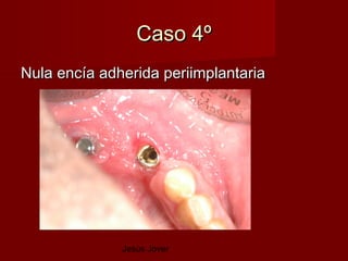 Caso 4º
Nula encía adherida periimplantaria




              Jesús Jover
 